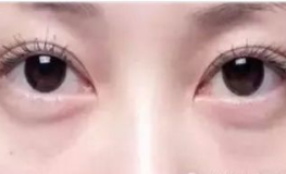 做完私密嫩红眼睛会肿吗,私密嫩红术后眼部肿胀常见吗？揭秘术后恢复真相